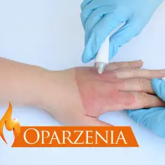 Ręka z oparzeniem, na którą nakładany jest krem. Dowiedz się, jak zrobić opatrunek na oparzenia.