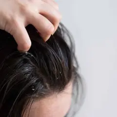 Mano rascando el cuero cabelludo con caspa visible. Aprende cómo hidratar el cuero cabelludo para aliviar la picazón y la sequedad.