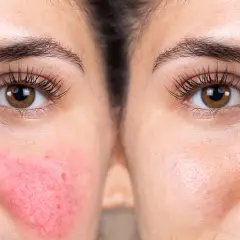 Före- och efterbilder av en ansiktshalva som visar rodnad och synliga blodkärl vid rosacea, jämfört med en klarare hud.