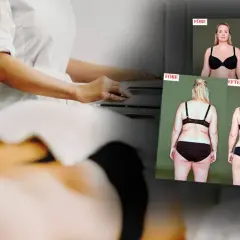 Före- och efterbilder visar resultat av coolsculpting armar. En person i vit rock utför behandling.