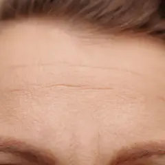 Close-up of a forehead with visible horizontal wrinkles and eyebrows.