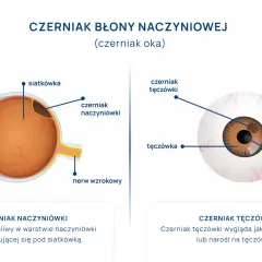 Ilustracje przedstawiają czerniaka oka: czerniak naczyniówki pod siatkówką i czerniak tęczówki. Ból oka może być objawem.