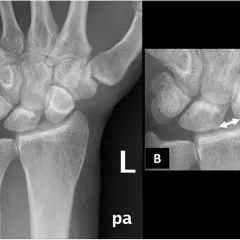 Radiografie del polso. L'immagine B evidenzia un aumento dello spazio tra radio e ulna, indicativo di lesione del legamento triangolare polso.