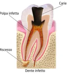 Sezione di un dente con carie e polpa infetta. Alla base della radice si nota un ascesso, segno di un dente infetto.