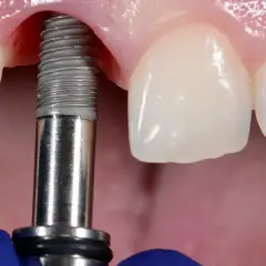 Zabieg wszczepienia implantu dentystycznego w szczękę. Widoczne narzędzie stomatologiczne i fragment implantu.