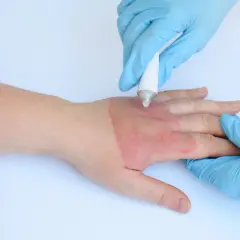 Application d'une crème sur une brûlure à l'eau bouillante. La guérison d'une brûlure eau bouillante combien de temps dépend de sa gravité.