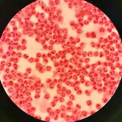 Mikroskopowy obraz komórek zapalnych i bakterii Neisseria gonorrhoeae, które mogą powodować rzeżączkę na penisie.