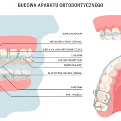 Ilustracja przedstawia budowę aparatu ortodontycznego na zębach, z opisami poszczególnych elementów.