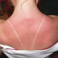 Dos lignes claires sur un dos rouge vif, témoignant d'un coup de soleil. Voici comment faire dérougir un coup de soleil.
