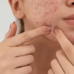 Haut mit Akne, die von Fingern berührt wird. Kollagen kann die wundheilung unterstützen.