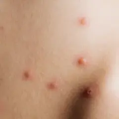 Piel con varias picaduras rojas e inflamadas, algunas con un punto central.