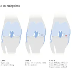 Illustrationen zeigen die Stadien der Arthrose im Kniegelenk, von gesundem Knorpel bis zum vollständigen Knorpeldefekt.