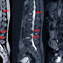 MRI kręgosłupa lędźwiowego pokazuje przepuklinę dysku, która może powodować silny ból. Czerwone strzałki wskazują na ucisk na rdzeń kręgowy.