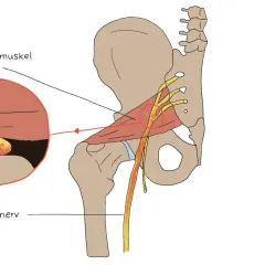 Illustration zeigt, wie der Ischiasnerv durch den Piriformis-Muskel komprimiert wird, was zu Schmerzen führt.