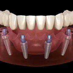 Immagine 3D di un'arcata dentale superiore con protesi fissa su quattro impianti, dimostrando la tecnica di implantologia all on four.