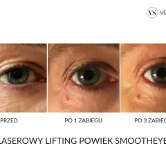 Przed i po zabiegach laserowego liftingu powiek. Efekty widoczne po 1 i 3 zabiegach. Laserowy lifting powiek ile się utrzymuje? Sprawdź efekty!