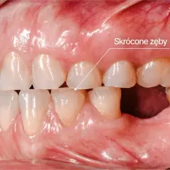 Zgrzytanie zębami w nocy może prowadzić do skrócenia zębów, jak widać na zdjęciu. Widoczne są starte zęby i ubytek w dolnym łuku.