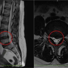 Widoczne na obrazach MRI kręgosłupa lędźwiowego zmiany wskazują na nieleczoną przepuklinę krążka międzykręgowego, uciskającą na struktury nerwowe.