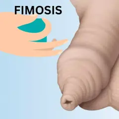 Ilustración de fimosis, una condición que puede afectar a niños. Se muestra un prepucio retraído y la acumulación de esmegma.