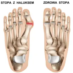 Jak powstają haluksy? Przyczyny, mechanizm i profilaktyka
