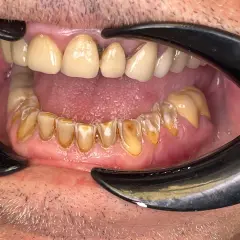Boca abierta con dientes amarillentos y desgastados, mostrando signos de **abrasión dental**. Se aprecian restauraciones y encías inflamadas.