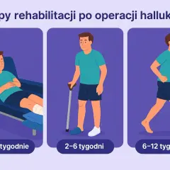 Bieganie po operacji haluksów: bezpieczny powrót krok po kroku?