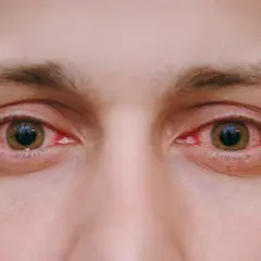 Oczy z widocznym zaczerwienieniem spojówek, objawem zapalenia oka.