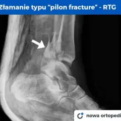 Złamana kostka boczna: Ile trwa leczenie i powrót do sprawności?