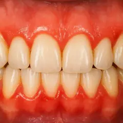 Gengive gonfie e arrossate, un segno di gengivite gravidica. Denti bianchi e sani, ma le gengive richiedono attenzione.