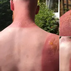Schwerer Sonnenbrand mit Blasenbildung an Schultern und Nacken. Die Frage "wie lange dauert ein sonnenbrand" wird hier schmerzhaft beantwortet.