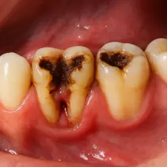 Dientes con caries severas, oscuras y cavidades profundas. Se observan encías inflamadas.