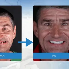 Uśmiech przed i po: brak zębów vs. pełny, piękny uśmiech po zabiegu implantacji.