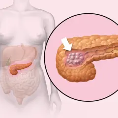 Ilustracja pokazuje trzustkę z guzem. Pytanie "rak trzustki ile się żyje" jest kluczowe dla pacjentów.