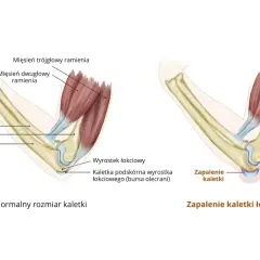 Spuchnięty łokieć bez przyczyny. Ilustracja pokazuje zapalenie kaletki łokciowej, powodujące obrzęk.