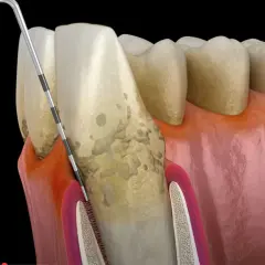 Ząb z kamieniem nazębnym i stanem zapalnym dziąseł. Narzędzie dentystyczne usuwa osad, łagodząc ból wszystkich zębów.