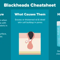 Punti neri e pori dilatati: un'illustrazione mostra un poro ostruito, con sebo e detriti che creano un punto nero. Soluzioni: detergente delicato e esfoliante BHA.