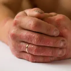 Dłonie z widocznymi, suchymi, łuszczącymi się i zaczerwienionymi **rdzawymi plamami** na skórze, z pierścionkiem na palcu.