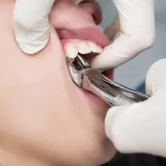 Dentysta usuwa ząb kleszczami. Zastanawiasz się, ile kosztuje wyrwanie zęba prywatnie?