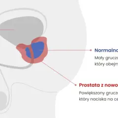 Choroba prostaty objawy - jak je rozpoznać i uniknąć powikłań