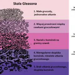 Skala Gleasona ilustruje stopnie zróżnicowania komórek w **adenocarcinoma prostatae gleason 7 (3+4)**, od małych gruczołów po naciek komórek.