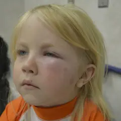 Silne uczulenie na komary u dziecka. Powieka jest mocno opuchnięta, zaczerwieniona, z widocznymi śladami ukąszeń na policzku.