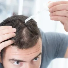 Mężczyzna aplikuje serum na skórę głowy, próbując zaradzić problemowi rzadkich włosów.