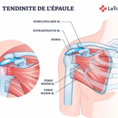 Illustration anatomique de la tendinite de l'épaule gauche, montrant les muscles et la bourse. Le stress peut aggraver la douleur à l'épaule.