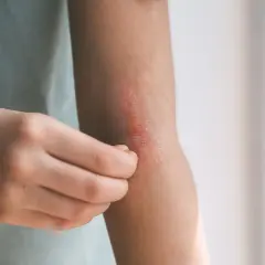 Skóra na łokciu swędzi i jest zaczerwieniona. Czas na wizytę u dermatologa, by znaleźć przyczynę i ulgę.