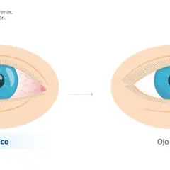 Ojo seco con irritación y enrojecimiento, comparado con un ojo normal y lubricado. Evita los ojos hinchados por la mañana.