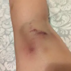 Widoczne siniaki na nodze, pamiątka po intensywnym treningu pole dance.