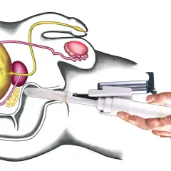 Darstellung der radikalen Prostatektomie: Ein chirurgisches Instrument wird eingeführt, um die Prostata zu entfernen.