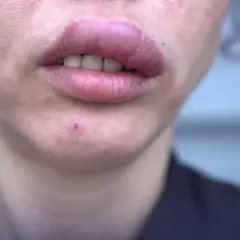 Alergia na sezam: 5 objawów które powinny cię zaniepokoić