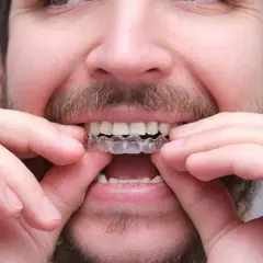 Rodzaje aparatów na zęby: które wybrać, by uniknąć błędów i zaoszczędzić?