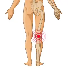 Röntgenbild des menschlichen Beins mit Fokus auf die Knieanatomie und Sehnen. Ein roter Kreis zeigt Schmerzen im Kniebereich an.